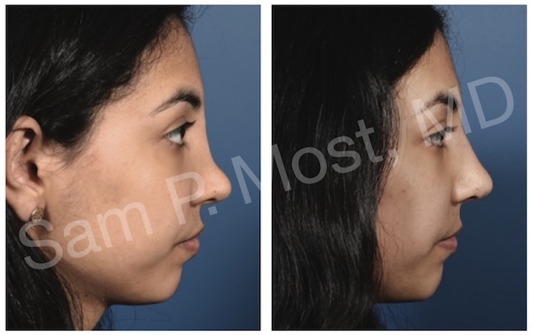 Revision Rhinoplasty Intro