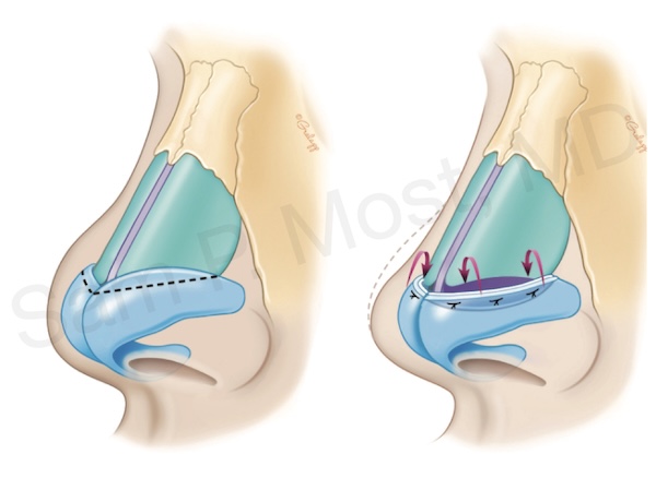 Cephalic turn-in flap