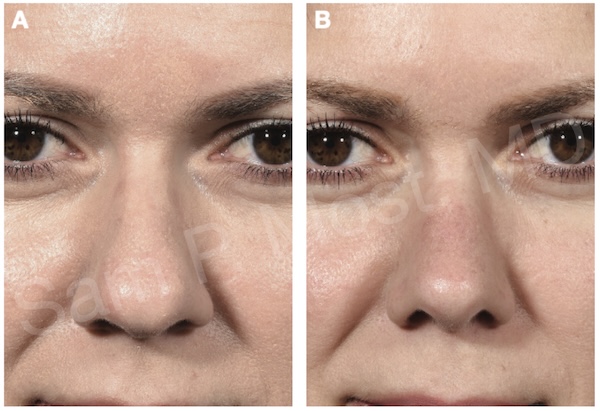 Patient with cephalic turn-in result