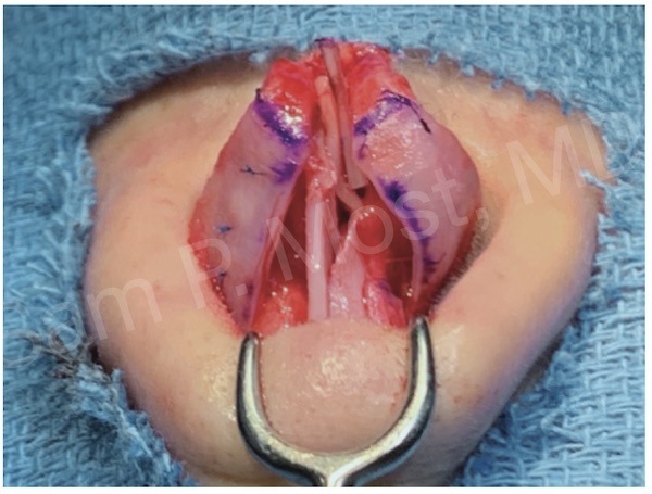 Mini-LCSG intraoperative photo
