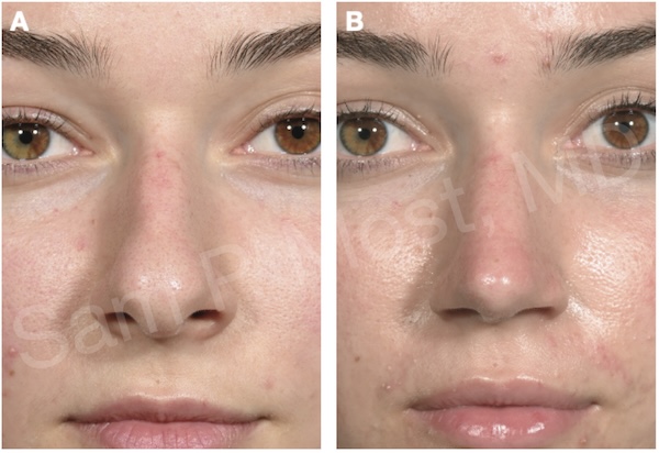 Lateral crural repositioning result