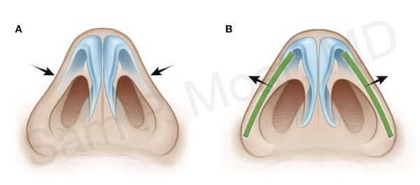 Rim grafts diagram