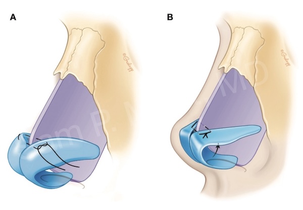 Alar spanning suture diagram