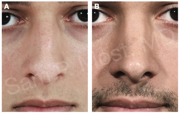 Patient result after dome sutures