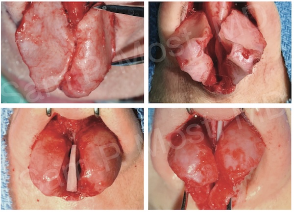 Examples of tip cartilage shapes