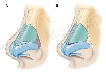 Cephalic trim example