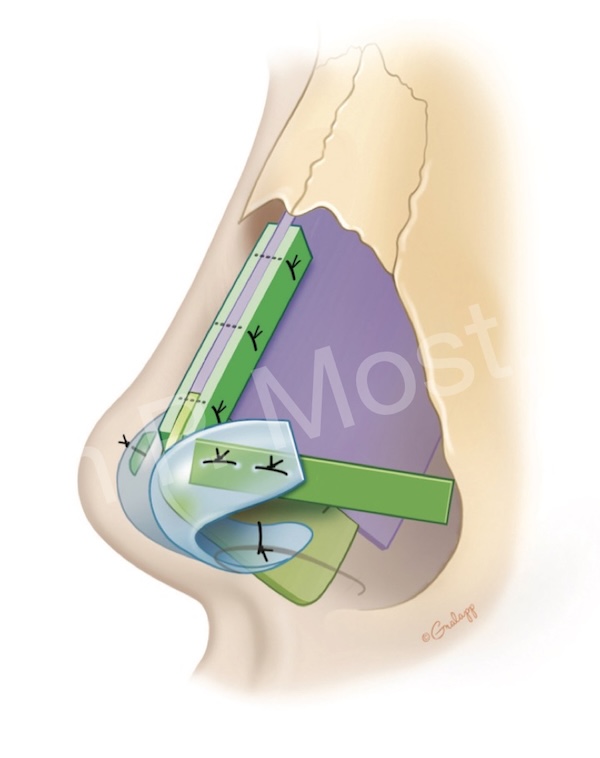 Fig 11-11