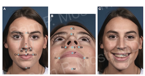 Figure 14-1: Key facial and nasal landmarks used in symmetry analysis