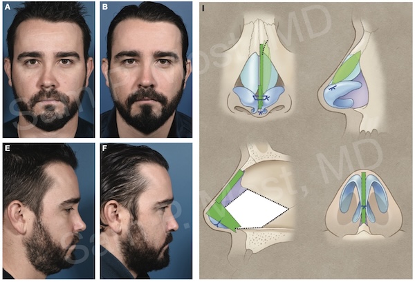 Figure 14-11: Unilateral osteotomy with dorsal and midvault augmentation