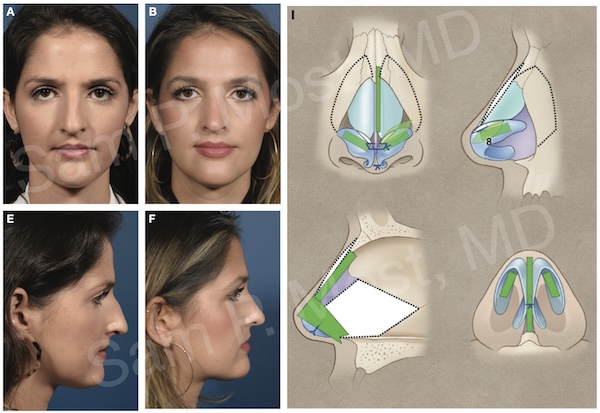 Figure 14-13: Complex deviation with dorsal work and tip support