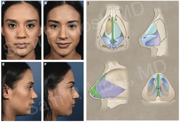 Figure 14-14: Correction of traumatic upper/midvault deviation