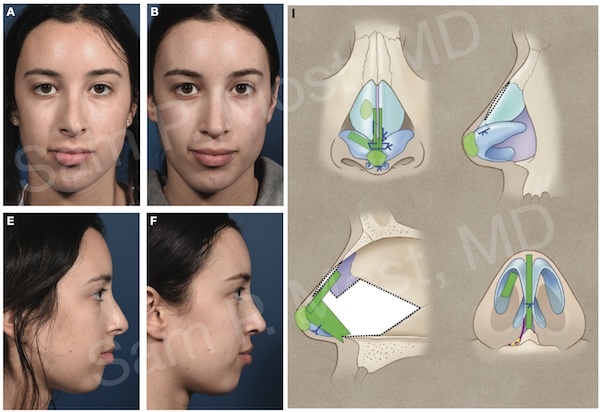 Figure 14-15: Correction of lower third deviation after prior surgery