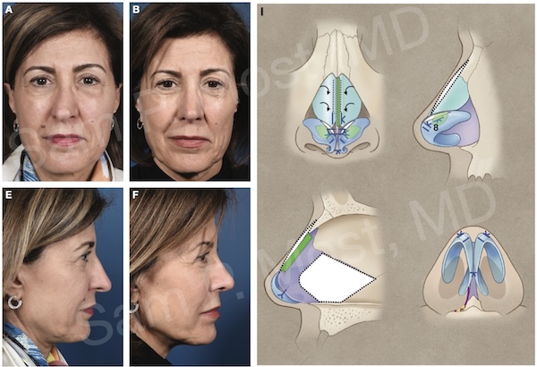 Figure 14-16: Combined deviation and airway treatment