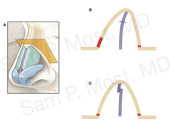 Figure 14-18: MSSM used to correct dorsal asymmetry via preservation method