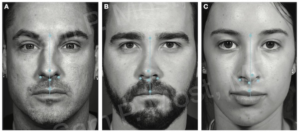 Figure 14-3: Examples of upper, middle, and lower third nasal deviations