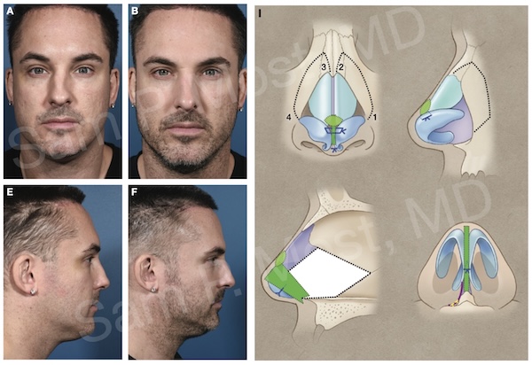 Figure 14-4: Upper third deviation treated with osteotomies and ASR