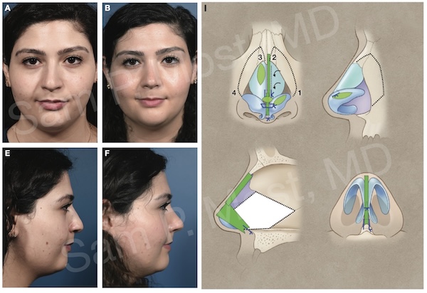 Figure 14-6: Correction of deviation with osteotomies and grafting