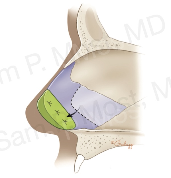 Figure 15–10: SEG placement