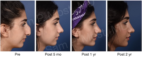 Before and progressive after lateral images of a large dorsal hump reduction