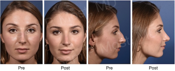 Before and after views of dorsal preservation