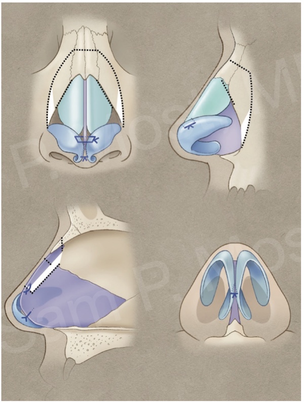Diagram of let-down dorsal preservation