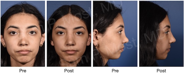 Before and after of saddle nose reconstruction