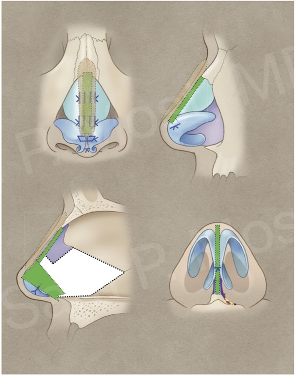 Diagram of saddle nose repair technique