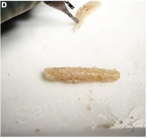 Example of diced rib/fibrin glue graft