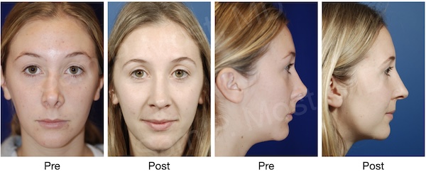 Before and after caudal reconstruction