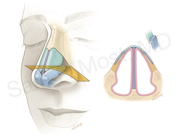 Figure 3–15: Internal nasal valve anatomy