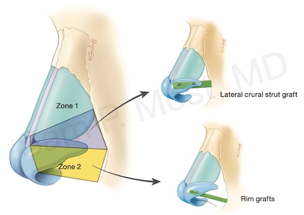 Figure 3–18: Nasal sidewall zones
