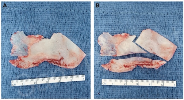 Figure 5–10: Harvested septum and ASR prep