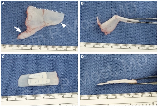 Figure 5–11: Batten graft support for ASR
