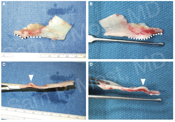 Figure 5–2: PQCE cartilage landmark