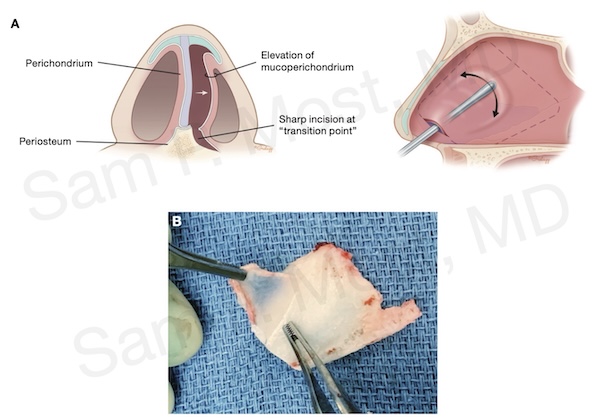 Figure 5–4: Mucoperichondrial elevation at septal junction