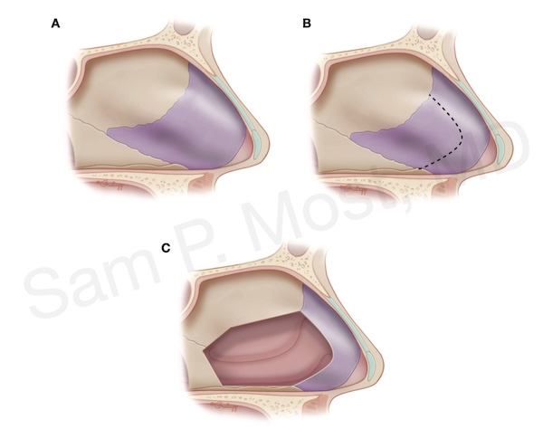 Figure 5–5: Septum before reshaping