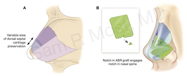 Figure 5–7: ASR graft technique