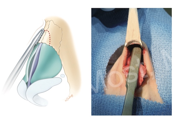 Figure 7-12: Rasping