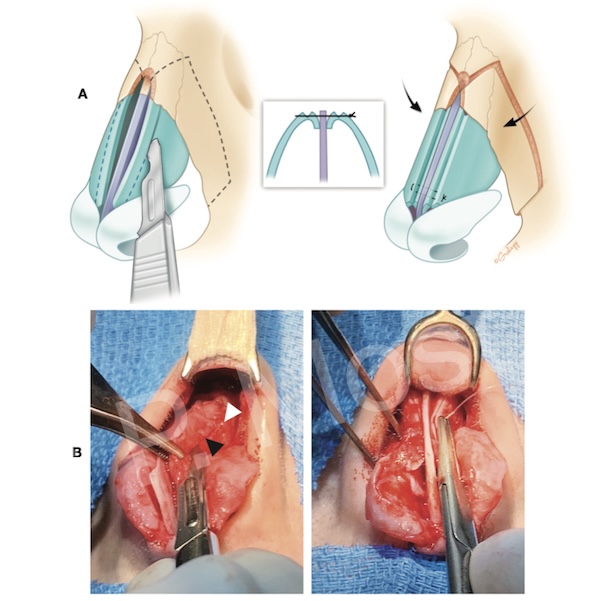 Figure 7-21: Post-osteotomy dorsal narrowing