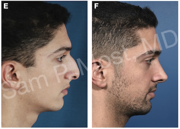 Figure 7-24: Patient with conventional hump resection