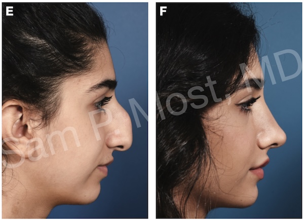 Figure 7-25: Patient with conventional hump resection