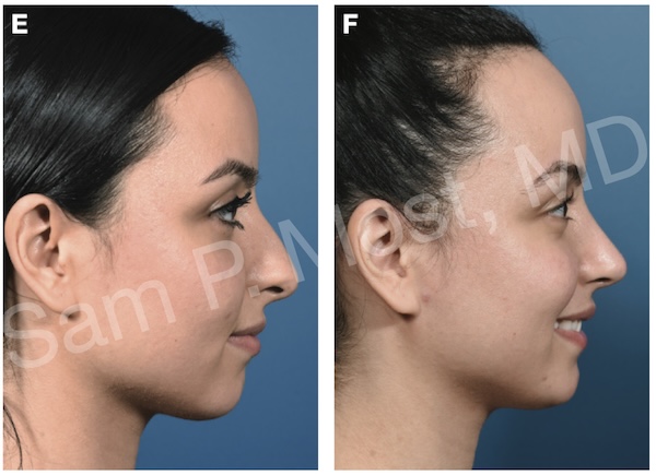 Figure 7-27: Patient with conventional hump resection