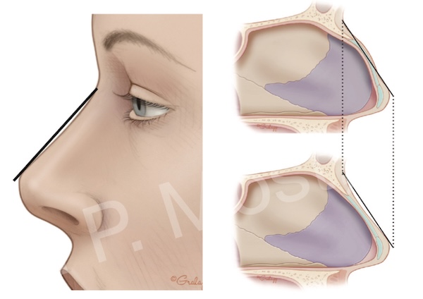 Figure 7-3: Dorsal profile assessment