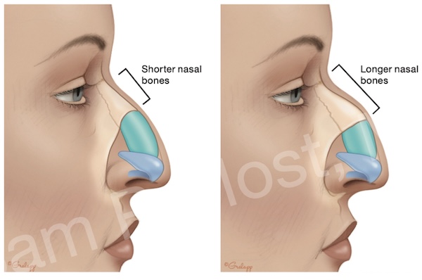 Figure 8-14: Nasal bone length