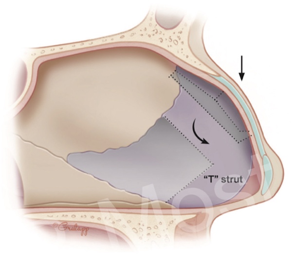 Figure 8-16: Modified subdorsal strip
