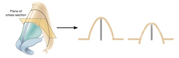 Figure 8-4: Push-down technique