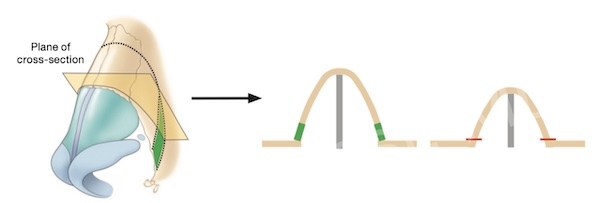 Figure 8-5: Let-down technique