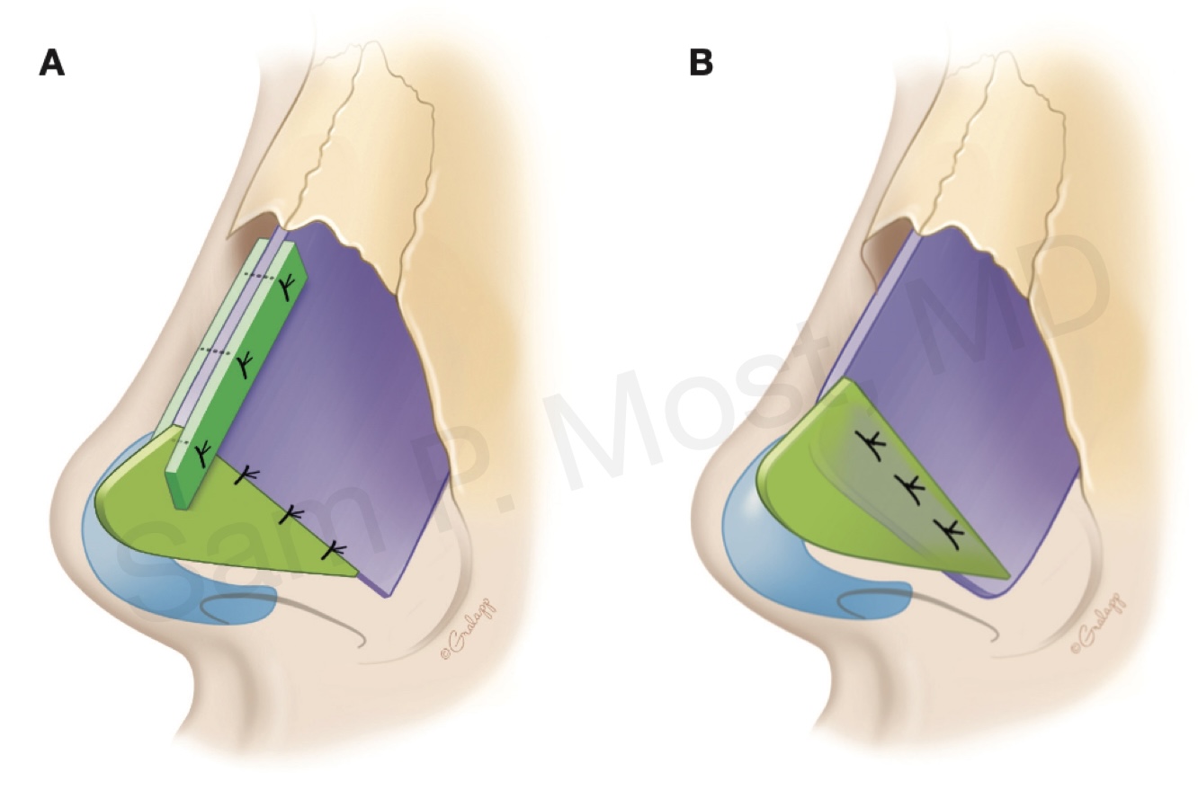 Figure 9-10: Septal extension graft options (in-line vs side-to-side)