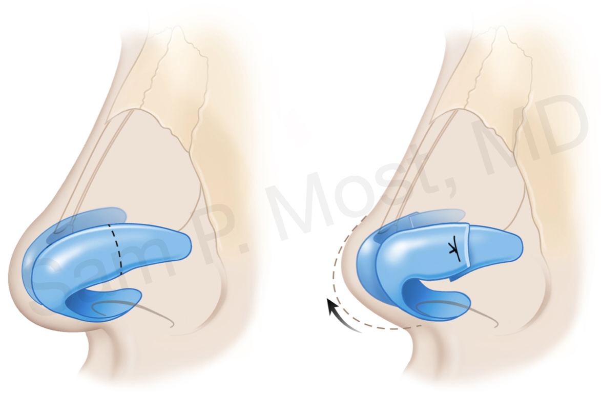 Figure 9-13: Lateral crural overlay schematic showing shortened cartilage