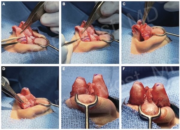 Figure 9-14: Intraoperative view of lateral crural overlay steps